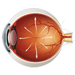 Dry Eye 1