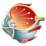 refractive surgery 1