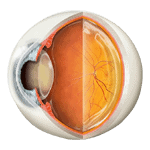 cataract